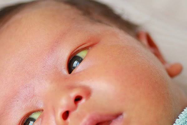 Newborn Jaundice